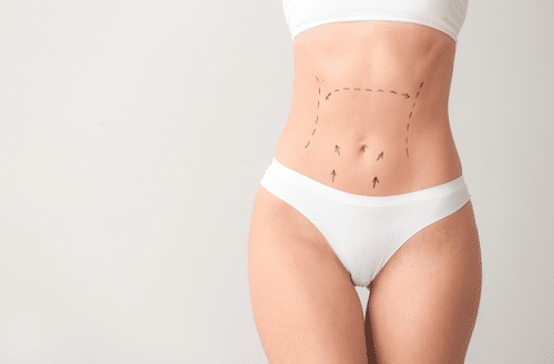 résultat-abdominoplastie